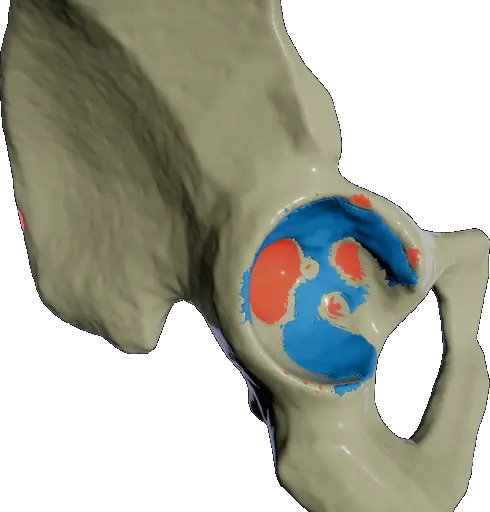 Visualization of a poorly reamed hip socket